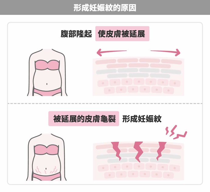 為什麼會出現妊娠紋?可以預防嗎?