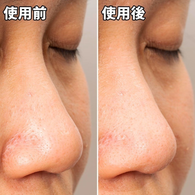 妙鼻貼（女用） 10