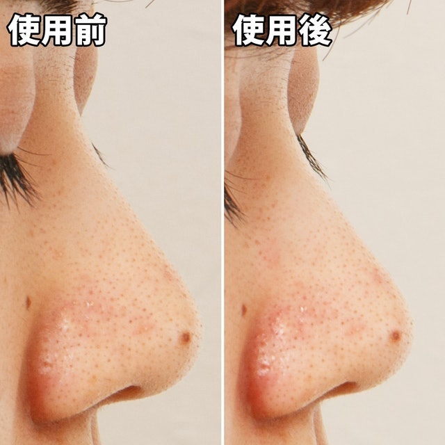 毛穴問題 凝膠型撕式鼻膜 10
