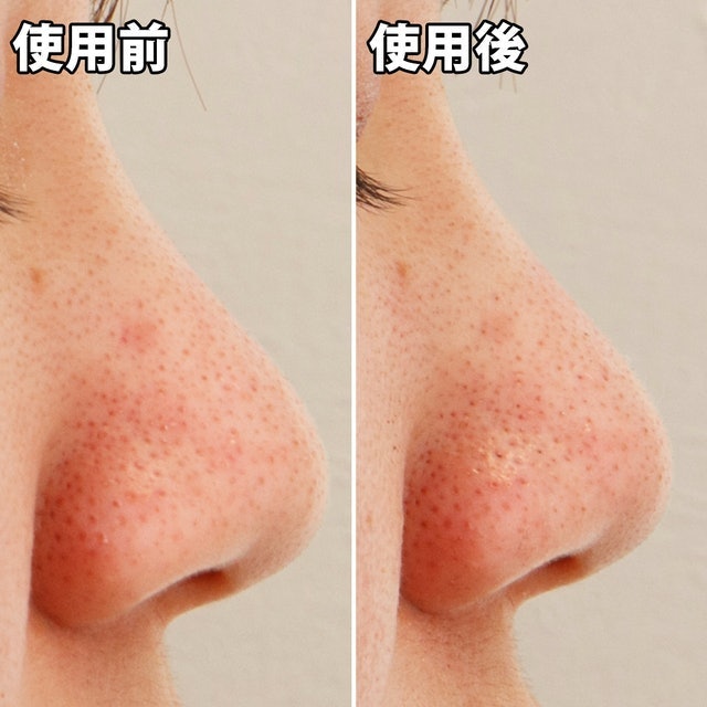 黑頭面膜 10