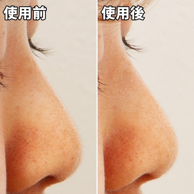 粉刺分手極凈鼻膜組 9