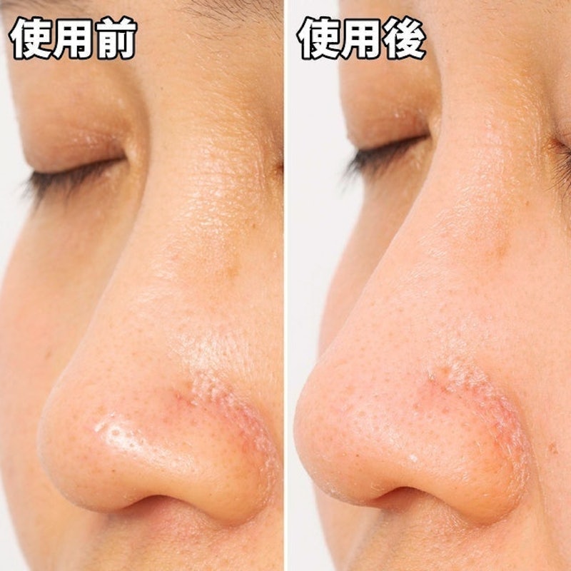 妙鼻貼(女用) 9