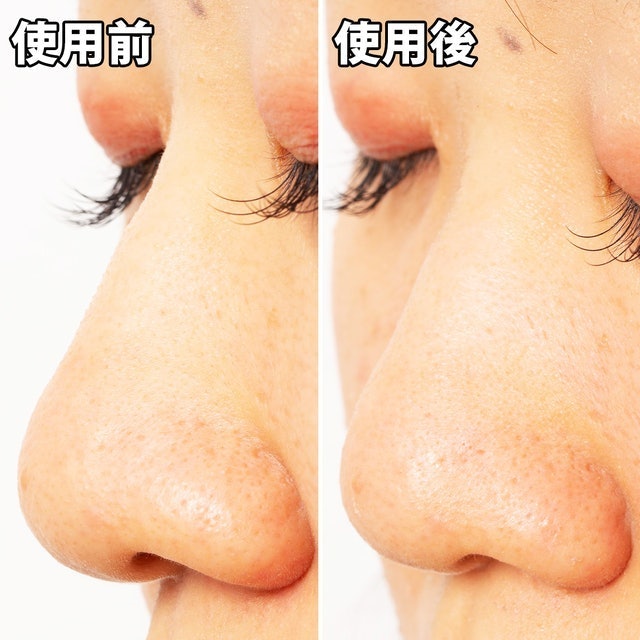 毛穴問題 凝膠型撕式鼻膜 6
