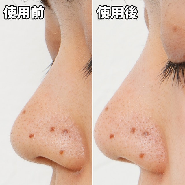 毛穴問題 凝膠型撕式鼻膜 9