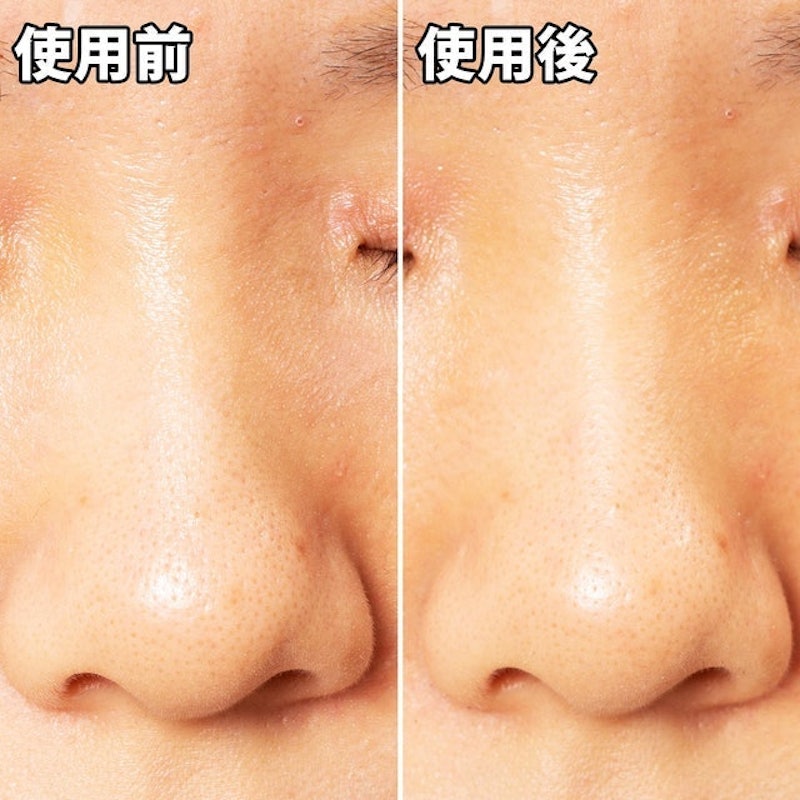 黑頭面膜 5