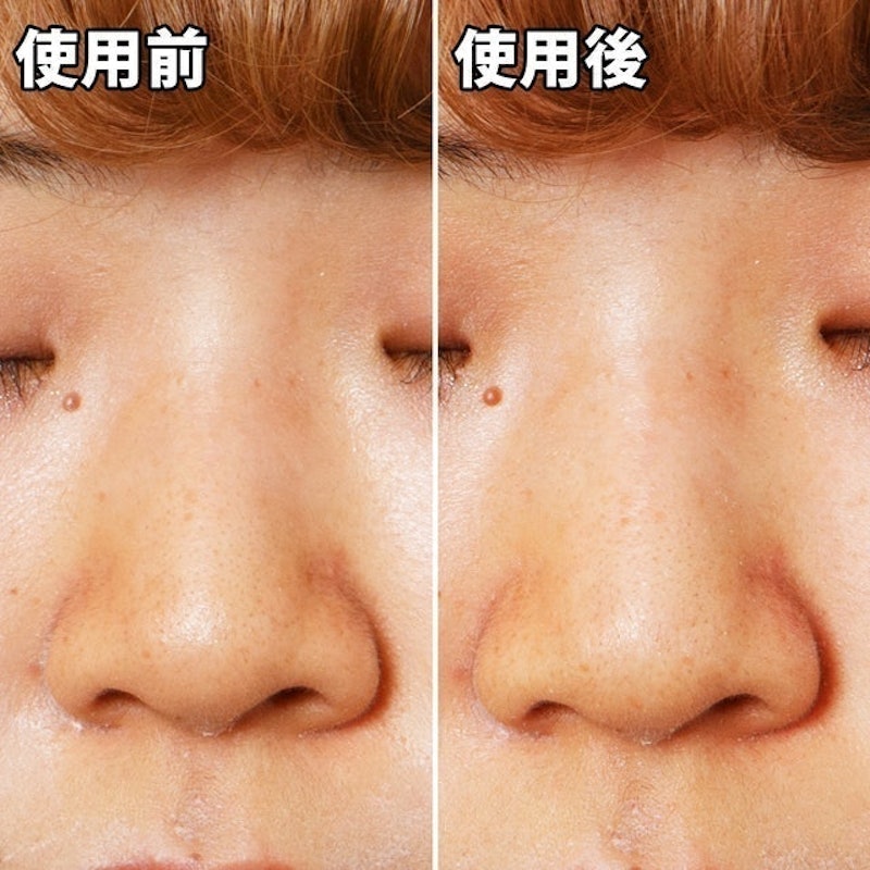 粉刺分手極凈鼻膜組 7