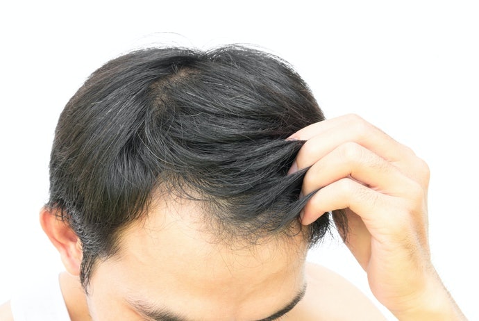 有搔癢、頭皮屑困擾者,推薦使用藥用洗髮精