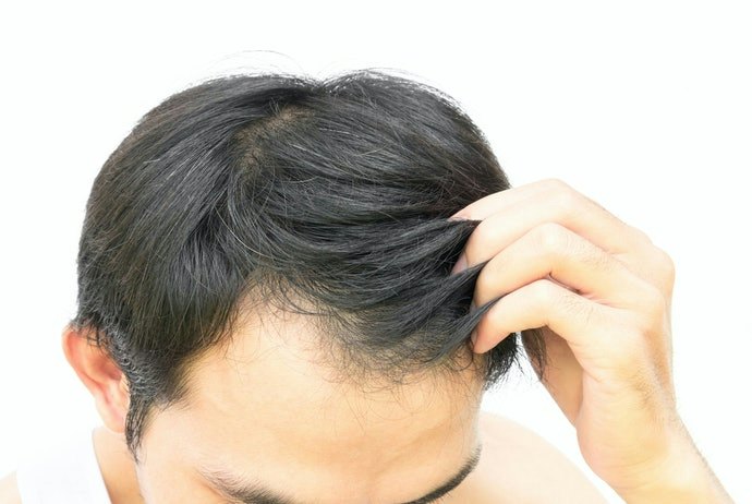 有搔癢、頭皮屑困擾者,推薦使用藥用洗髮精