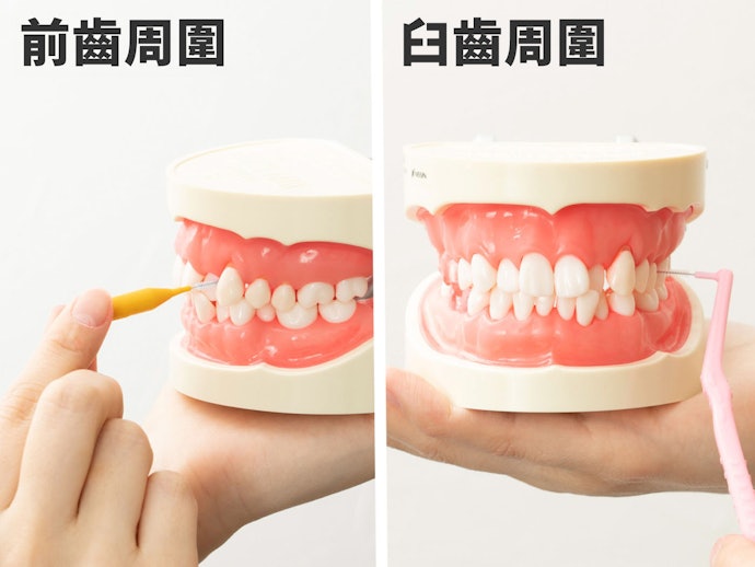 I字型適合前排牙齒、L型適合臼齒